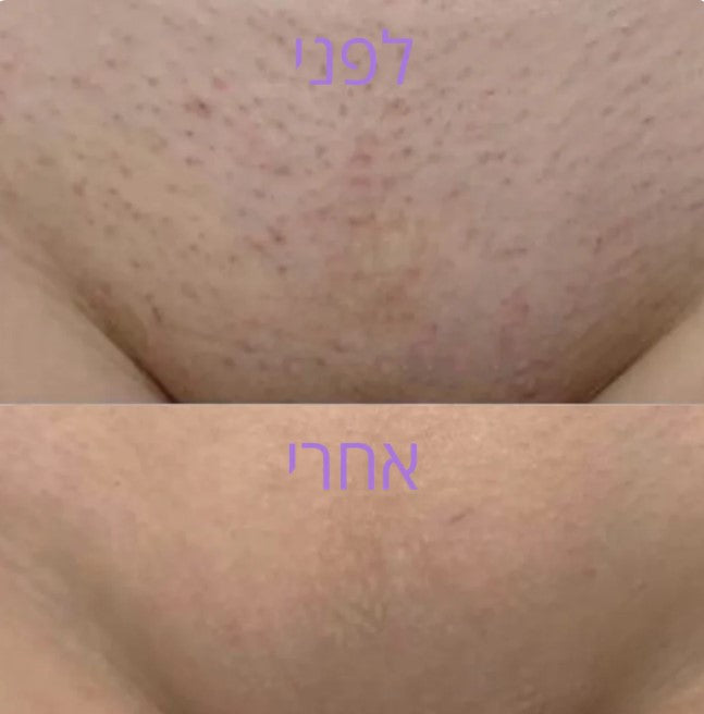 מכשיר להסרת שיער