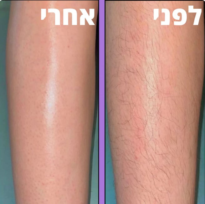 מכשיר להסרת שיער